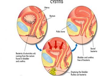 Những điều cần biết về bệnh viêm đường tiết niệu