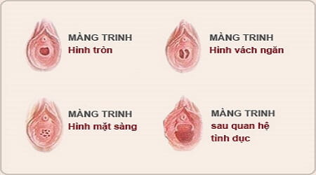 Màng trinh bị rách trước hôn nhân - Vực thẳm của hạnh phúc gia đình