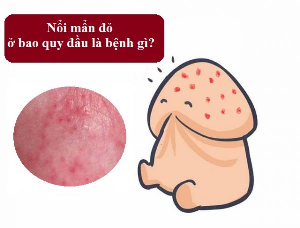 Đầu Dương Vật Nổi Mẩn đỏ Ngứa Cảnh Giác 8 Bệnh Nguy Hiểm