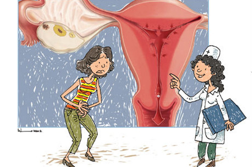 Bệnh viêm buồng trứng ở nữ giới