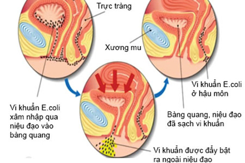Nhiễm trùng đường tiểu nam