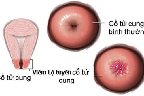 Hình ảnh các giai đoạn bệnh viêm lộ tuyến cổ tử cung