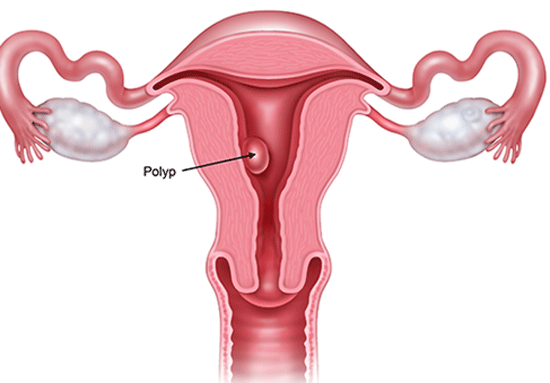 Polyp tử cung nếu không chữa trị kịp thời có thể gây ung thư tử cung