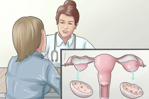 Phương pháp hỗ trợ chữa viêm buồng trứng