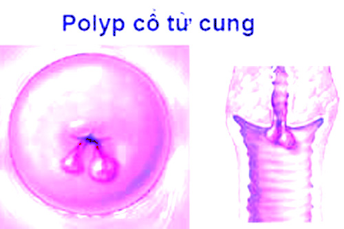 tong-quan-ve-polyp-co-tu-cung-3 (1)