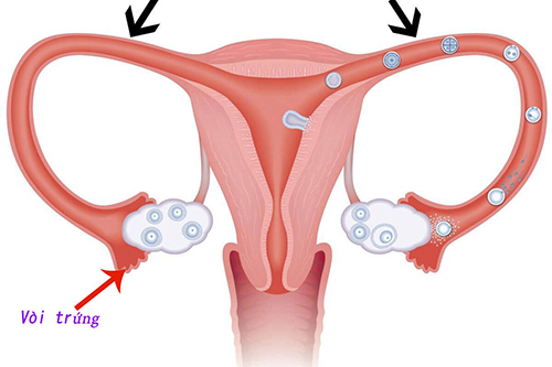 Tìm hiểu về viêm tắc vòi trứng ở nữ giới